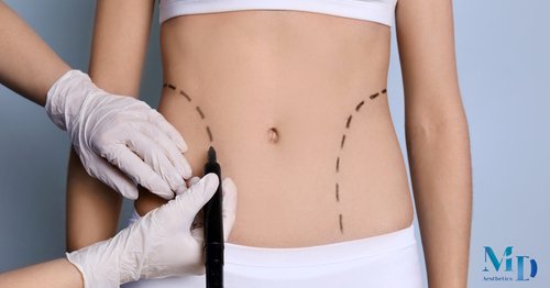 Body Lift Surgery: Restoring Proportion and Comfort After Major Weight Loss